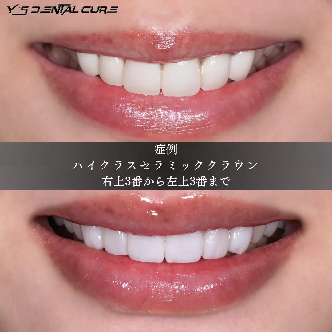 あの、歯科のやりなおしです。つながっていた歯を一本ずつに