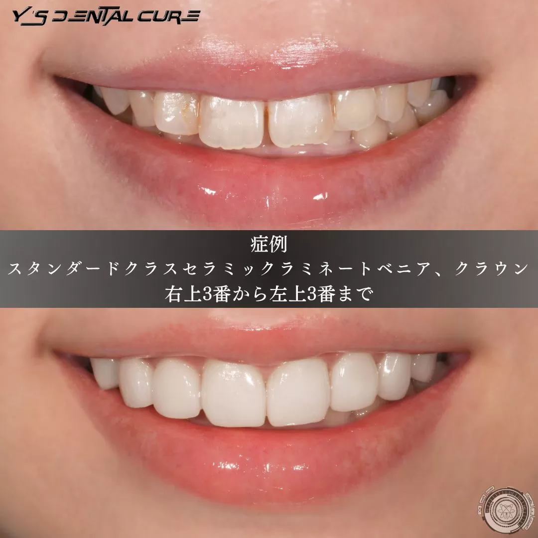 整える、ということを主眼においた2Dセラミックの症例。