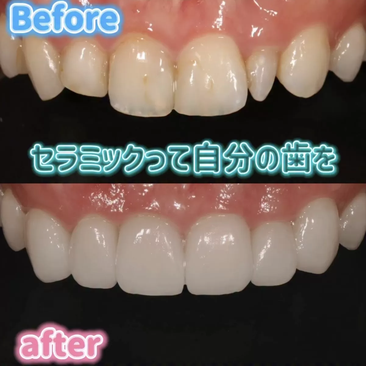 このような削る量を最小限に抑えた治療を得意としています。