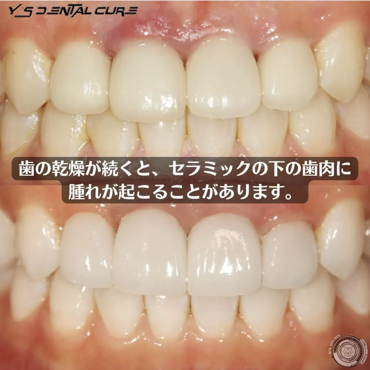 歯の乾燥を引き起こすセラミックの再治療