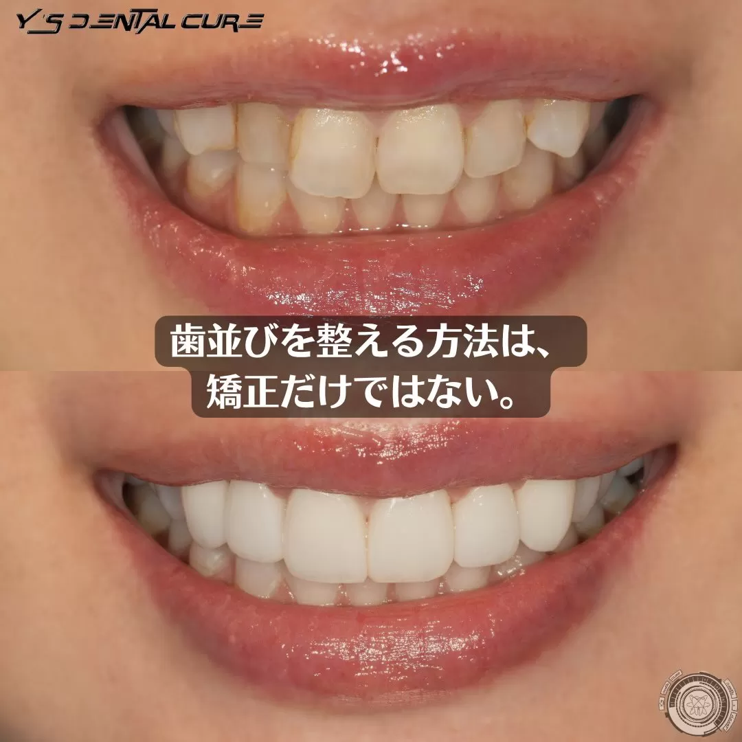 歯並びを整える方法は矯正だけではない。