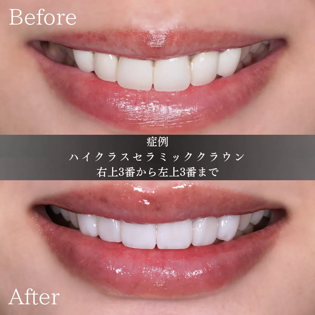 あの、歯科のやりなおしです。つながっていた歯を一本ずつに