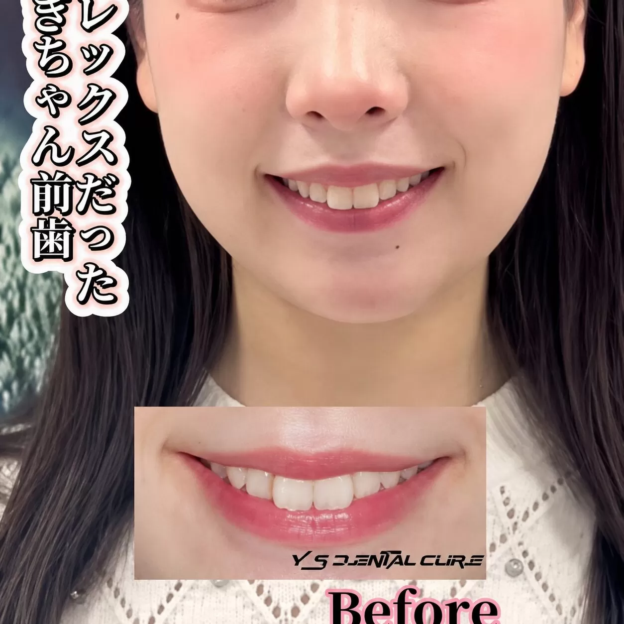 コンプレックスだったうさぎちゃん前歯